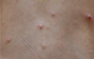  今年感染病毒什么症状最严重(病毒感染一般要烧几天)