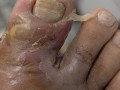  疫情后遗症有多可怕(新冠后遗症是永久的还是暂时的)