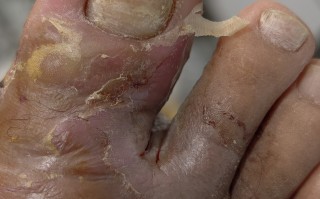  疫情后遗症有多可怕(新冠后遗症是永久的还是暂时的)