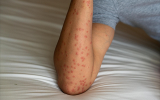  疫情病毒后遗症有哪些呢图片视频(埃博拉病毒是什么症状)