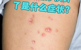  最近病毒性感冒症状有哪些表现图片(最近的病毒感冒)