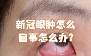  疫情啥症状?(中国三年疫情死亡人数)