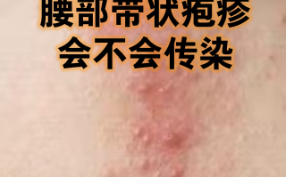  最近传染病叫什么2019(近期传染)