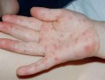现在的病毒有哪些症状图片和视频的简单介绍