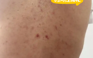  现在的流行病是什么症状2020(2020新型肺炎具体症状)