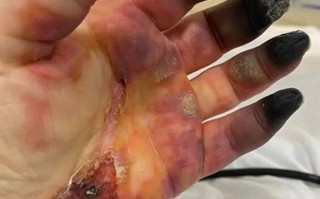  疫情后遗症是什么症状(疫情后遗症是什么症状啊)