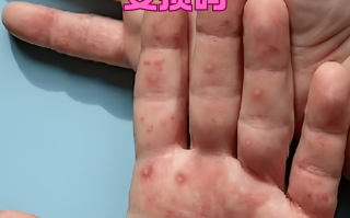 hp是什么病毒感染引起的(感染hpv51型有什么症状吗)