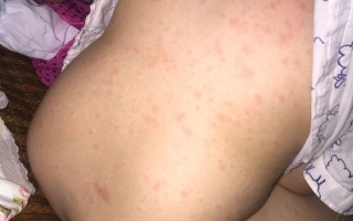  近期什么病毒引起发烧症状(最近的病毒性发烧是什么原因)