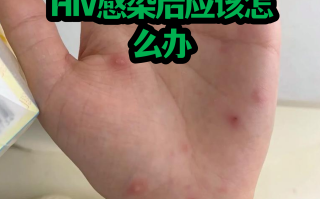  感染了疫情能治好吗(乙肝自愈的15个征兆)