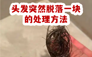  最近掉发严重有什么方法解决(最近掉发特别严重怎么办)