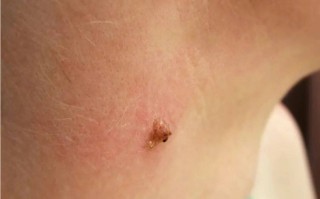  hpv病毒症状图片(hpv病毒症状图片大全)