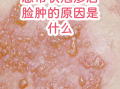  带状疱疹是什么病毒引起的原因(初期疱疹图片)