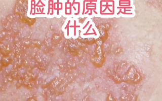  带状疱疹是什么病毒引起的原因(初期疱疹图片)