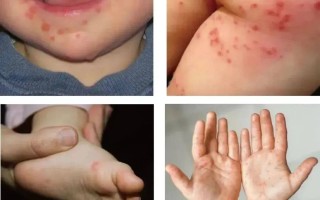  现在孩子流行什么病毒(最近儿童感染的病毒叫什么)