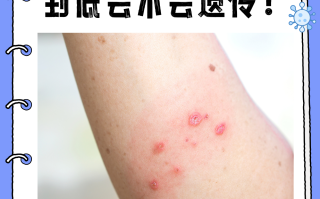  中国非典是什么年代的病毒(非典是消失了还是治愈了)