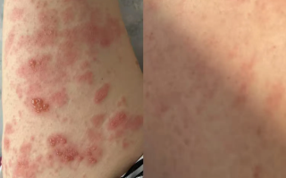  广东最近爆发的传染病图片(广东近期传染病毒)