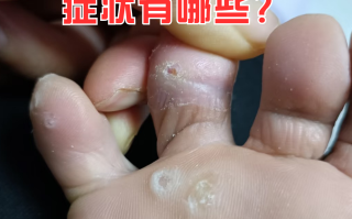 现在流行什么病毒?感染症状是什么?(最近流感病毒最新症状)