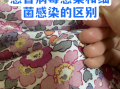  小孩感冒是病毒感染严重还是细菌感染严重(细菌感染一般几天自愈)