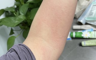  疫情后遗症有哪三大症状(疫情后遗症有多可怕)