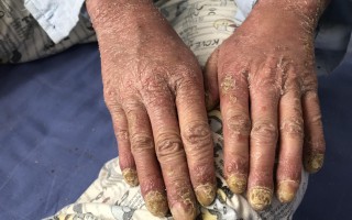  疫情患者治好之后有什么后遗症吗知乎视频(疫情治疗后的人)