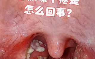  嗓子发炎是什么感染(嗓子发炎是啥)