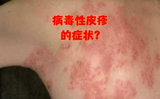 最近的病毒感染有什么症状(各种病毒感染症状)