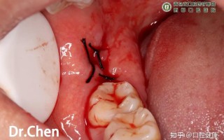  疫情治愈后有后遗症吗知乎(这次疫情治愈后有后遗症吗)