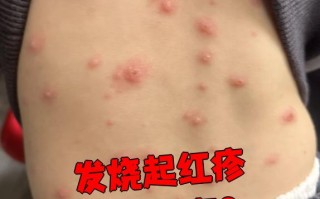 是什么病毒感染会引起发热和起丘疹呢的简单介绍