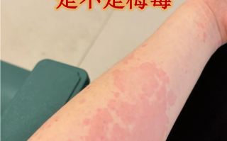  疫情发生的症状表现(疫情 发生)