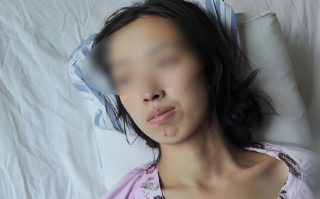  新冠肺炎后遗症有多恐怖(新冠肺炎后遗症都有啥)