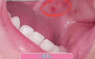  病毒性嗓子疼什么症状(病毒性嗓子疼吃什么药最管用)