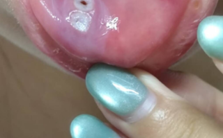  什么病毒会引起持续发烧口腔溃疡发作(什么病毒会引起发烧呕吐)