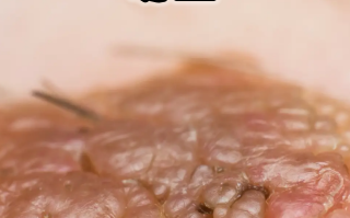  现在最严重的相关病毒在哪里(腺病毒17天表现症状图)