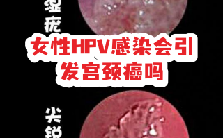  哪种hpv病毒最严重女性(一旦得了hpv最明显的征兆)