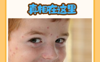  小孩最近流行什么病毒引起2020(现在小孩流行的什么病毒感染)