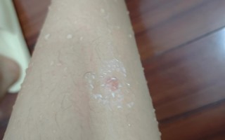 广州蚊子咬的包一直痒(被蚊子咬然后包一直痒不消)
